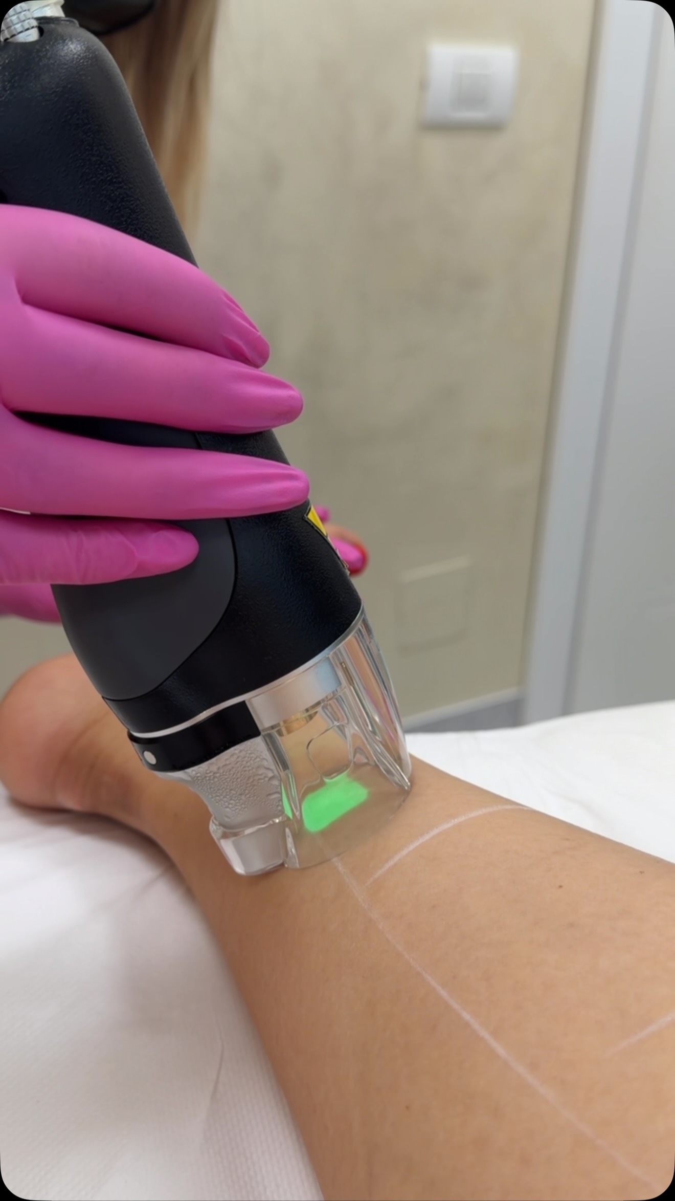 Epilare definitivă laser